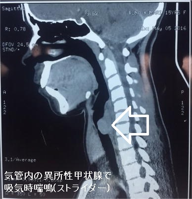 気管内の異所性甲状腺で吸気時喘鳴(ストライダー) 気管内の異所性甲状腺で吸気時喘鳴(ストライダー)