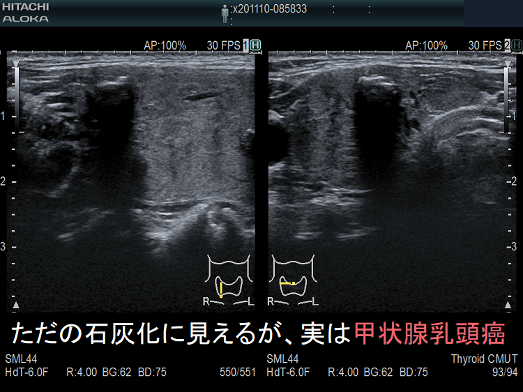 ただの石灰化に見えるが、実は甲状腺乳頭癌 超音波(エコー)画像 ただの石灰化に見えるが、実は甲状腺乳頭癌 超音波(エコー)画像