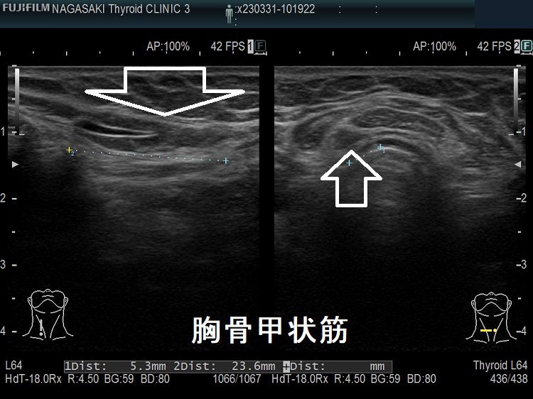 甲状腺乳頭癌切除後局所再発ではなく胸骨甲状筋 超音波(エコー)画像 甲状腺乳頭癌切除後局所再発ではなく胸骨甲状筋 超音波(エコー)画像