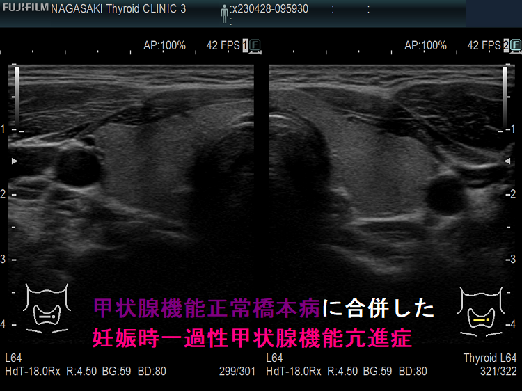 甲状腺機能正常橋本病に合併した妊娠時一過性甲状腺機能亢進症 甲状腺機能正常橋本病に合併した妊娠時一過性甲状腺機能亢進症