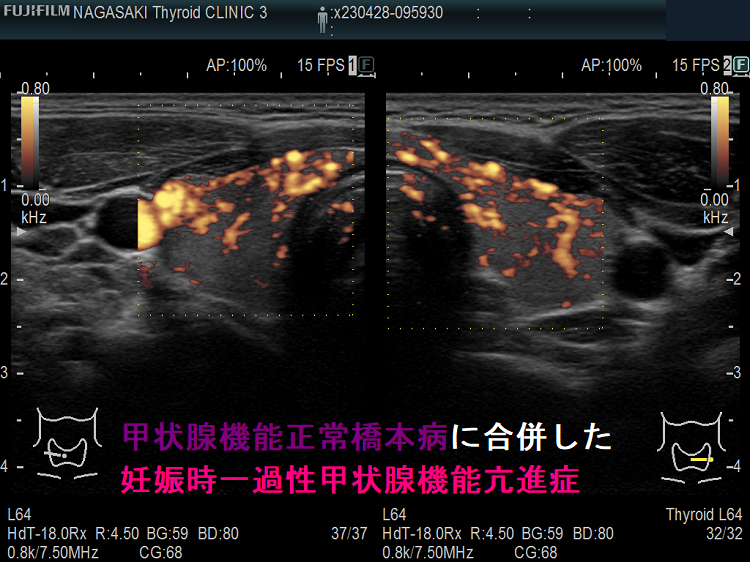 甲状腺機能正常橋本病に合併した妊娠時一過性甲状腺機能亢進症 ドプラーモード 甲状腺機能正常橋本病に合併した妊娠時一過性甲状腺機能亢進症 ドプラーモード