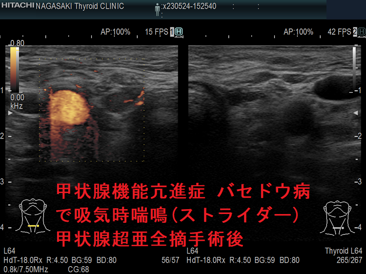 甲状腺機能亢進症 バセドウ病で吸気時喘鳴(ストライダー)甲状腺超亜全摘手術後 ドプラーモード 甲状腺機能亢進症 バセドウ病で吸気時喘鳴(ストライダー)甲状腺超亜全摘手術後 ドプラーモード