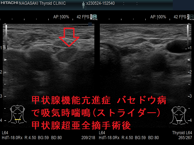 甲状腺機能亢進症 バセドウ病で吸気時喘鳴(ストライダー)甲状腺超亜全摘手術後 甲状腺機能亢進症 バセドウ病で吸気時喘鳴(ストライダー)甲状腺超亜全摘手術後