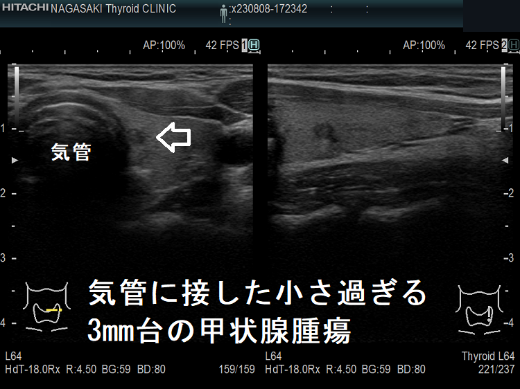 気管に接した小さ過ぎる3mm台の甲状腺腫瘍 気管に接した小さ過ぎる3mm台の甲状腺腫瘍