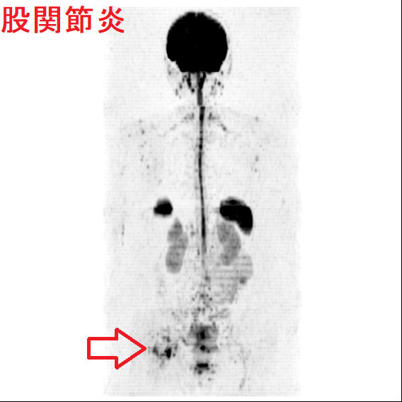 股関節炎 股関節炎