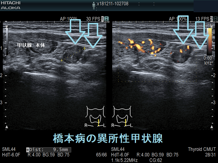 橋本病の異所性甲状腺 超音波(エコー)画像 ドプラーモード 橋本病の異所性甲状腺 超音波(エコー)画像 ドプラーモード