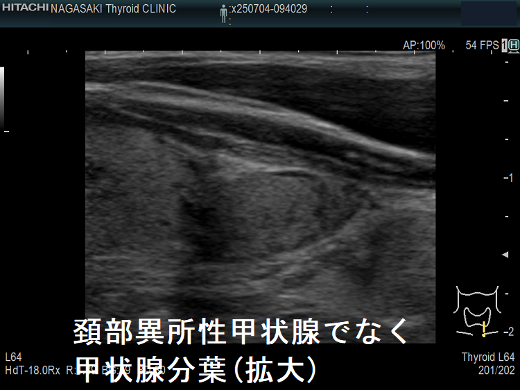 頚部異所性甲状腺でなく甲状腺分葉(拡大) 頚部異所性甲状腺でなく甲状腺分葉(拡大)