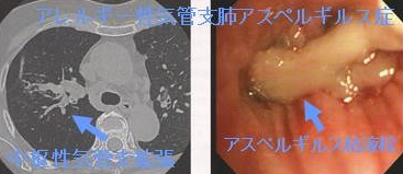 アレルギー性気管支肺アスペルギルス症 アレルギー性気管支肺アスペルギルス症