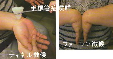 ティネル徴候、ファーレン徴候 ティネル徴候、ファーレン徴候