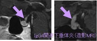 IgG4関連下垂体炎 IgG4関連下垂体炎