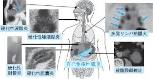 自己免疫性膵炎 自己免疫性膵炎