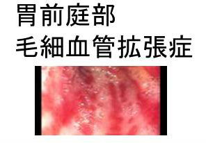 胃前庭部毛細血管拡張症 胃前庭部毛細血管拡張症