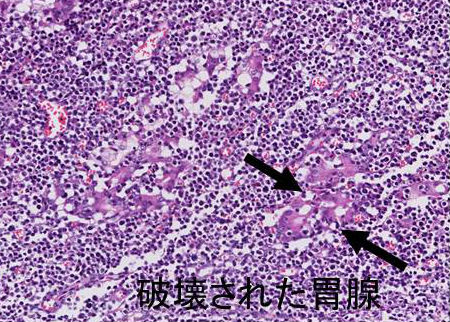 胃MALTリンパ腫 病理組織 胃MALTリンパ腫 病理組織