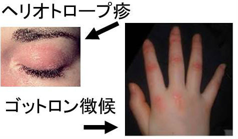 甲状腺の病気と似ている合併している皮膚筋炎 甲状腺の病気と似ている合併している皮膚筋炎