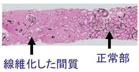 IgG4関連腎臓病 病理組織像 IgG4関連腎臓病 病理組織像