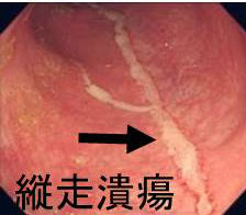 膠原線維性大腸炎 膠原線維性大腸炎