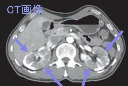 IgG4関連腎臓病 造影CT画像 IgG4関連腎臓病 造影CT画像