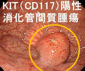KIT(CD117)陽性消化管間質腫瘍(GIST;ジスト) KIT(CD117)陽性消化管間質腫瘍(GIST;ジスト)