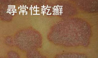 尋常性乾癬 尋常性乾癬