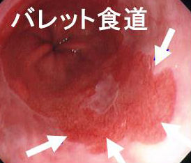 バレット食道 バレット食道