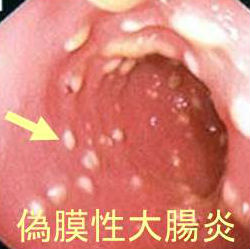 偽膜性大腸炎 偽膜性大腸炎