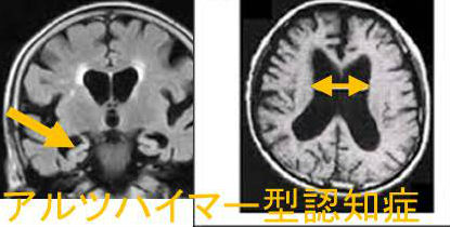 アルツハイマー型認知症 MRI画像 アルツハイマー型認知症 MRI画像