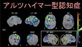 アルツハイマー型認知症 アルツハイマー型認知症