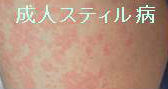 成人スティル病(成人発症Still病:Adult Onset Still's Disease:AOSD) 成人スティル病(成人発症Still病:Adult Onset Still's Disease:AOSD)