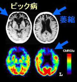前頭側頭型認知症(ピック病) 前頭側頭型認知症(ピック病)