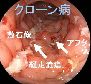 クローン病 内視鏡写真 クローン病 内視鏡写真