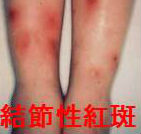 結節性紅斑 結節性紅斑