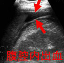 甲状腺乳頭癌の腹腔内出血 甲状腺乳頭癌の腹腔内出血