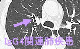 IgG4関連肺疾患 IgG4関連肺疾患