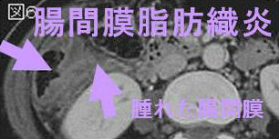 腸間膜脂肪織炎もIgG4関連疾患 腸間膜脂肪織炎もIgG4関連疾患