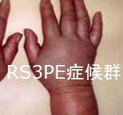 RS3PE症候群 RS3PE症候群