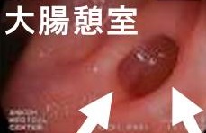 大腸、便秘・下痢と甲状腺 大腸、便秘・下痢と甲状腺