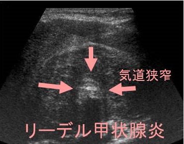 リーデル甲状腺炎 超音波(エコー)像 リーデル甲状腺炎 超音波(エコー)像