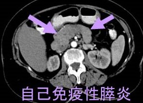 自己免疫性膵炎 自己免疫性膵炎