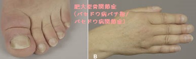 肥大型骨関節症 肥大型骨関節症