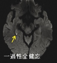 一過性全健忘 一過性全健忘