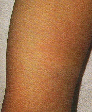 伝染性紅斑 網目状紅斑 伝染性紅斑 網目状紅斑