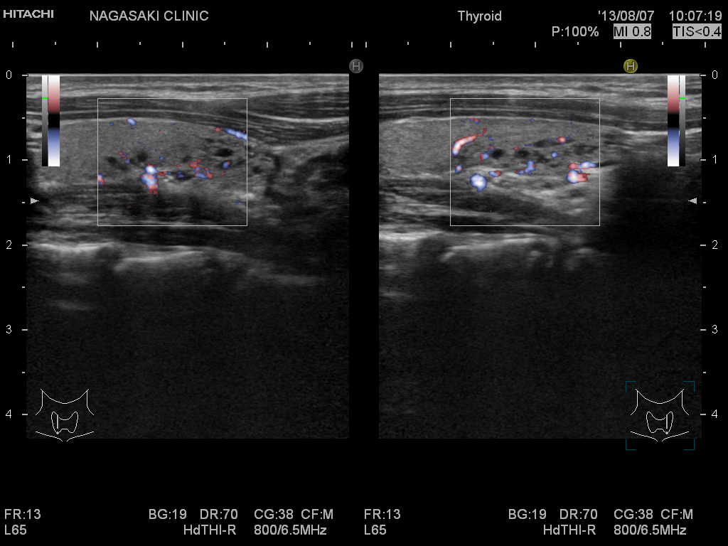 小児甲状腺超音波(エコー)検査・小児甲状腺癌[橋本病 超音波