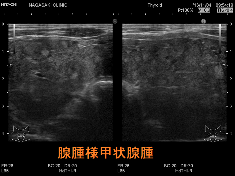腺腫様甲状腺腫 腺腫様結節 超音波(エコー)画像 腺腫様甲状腺腫 腺腫様結節 超音波(エコー)画像