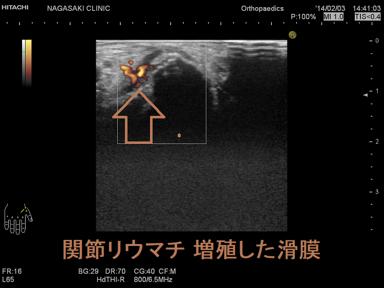 関節超音波(エコー)検査 関節超音波(エコー)検査