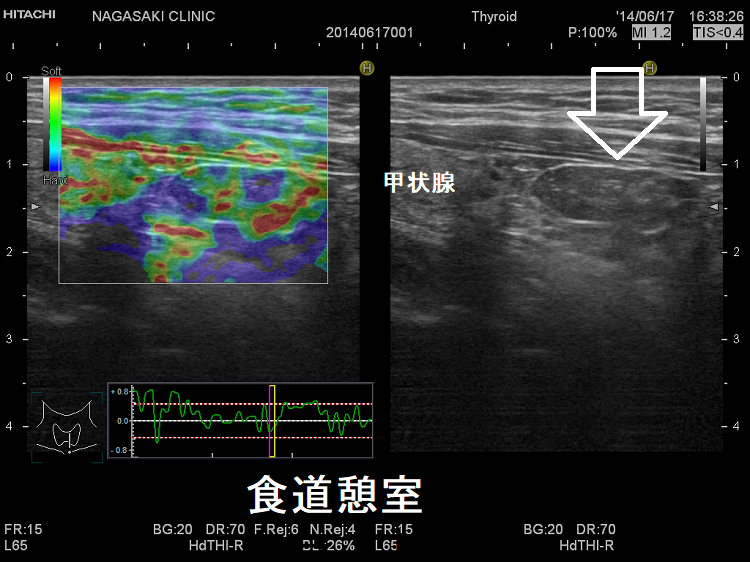 食道憩室 甲状腺超音波(エコー)画像 エラストグラフィー 食道憩室 甲状腺超音波(エコー)画像 エラストグラフィー