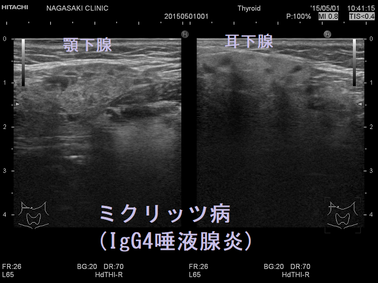 ミクリッツ病(Mikulicz病、IgG4唾液腺炎、IgG4関連硬化性唾液腺炎) ミクリッツ病(Mikulicz病、IgG4唾液腺炎、IgG4関連硬化性唾液腺炎)