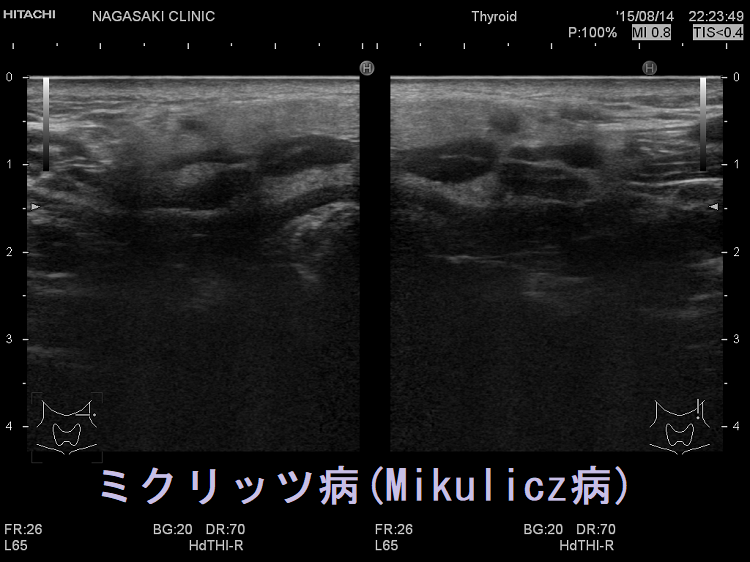ミクリッツ病(Mikulicz病、IgG4唾液腺炎、IgG4関連硬化性唾液腺炎) 超音波(エコー)像 ミクリッツ病(Mikulicz病、IgG4唾液腺炎、IgG4関連硬化性唾液腺炎) 超音波(エコー)像