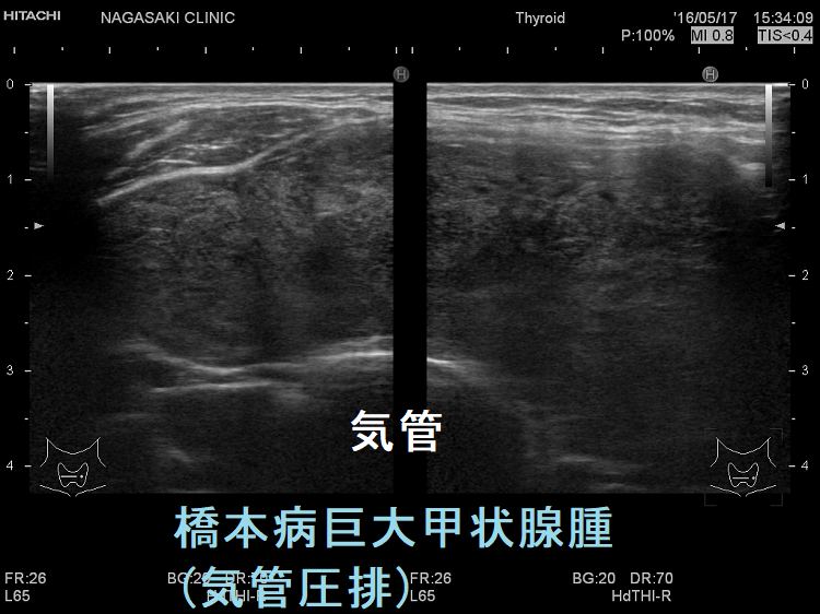 橋本病巨大甲状腺腫(気管圧排) 橋本病巨大甲状腺腫(気管圧排)
