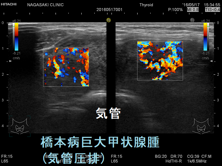 橋本病巨大甲状腺腫(気管圧排)ドプラーモード 橋本病巨大甲状腺腫(気管圧排)ドプラーモード