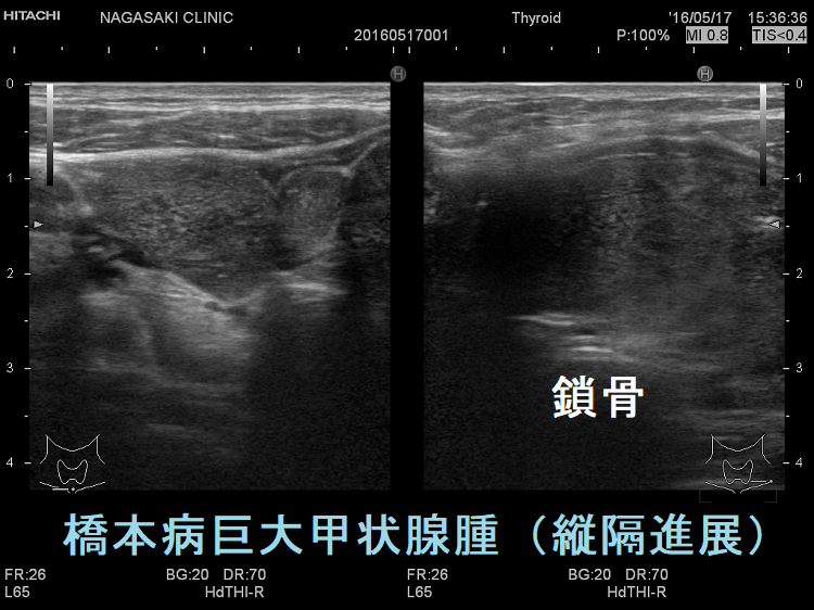 橋本病(縦隔進展) 橋本病(縦隔進展)